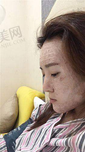 五、自体面部脂肪填充的成效和修复