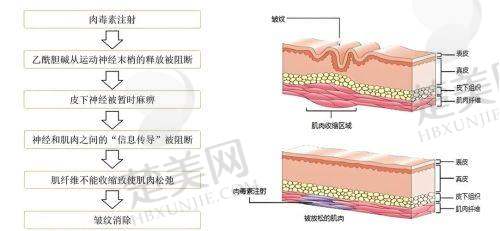 五、总结：润致5号玻尿酸是美容抗衰的好帮手