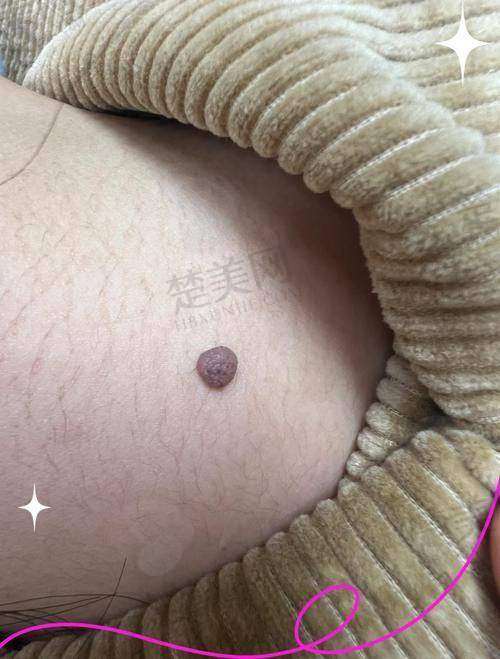 二、特殊部位切痣价格（按位置分类）