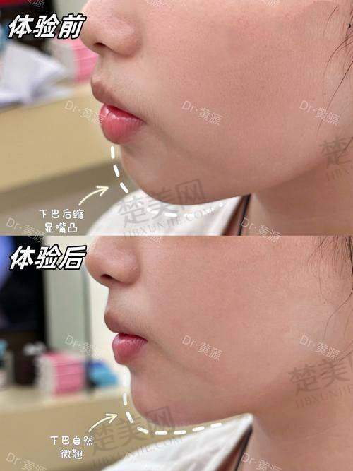 六、总结——Peek材质修复下颌骨靠谱又有效