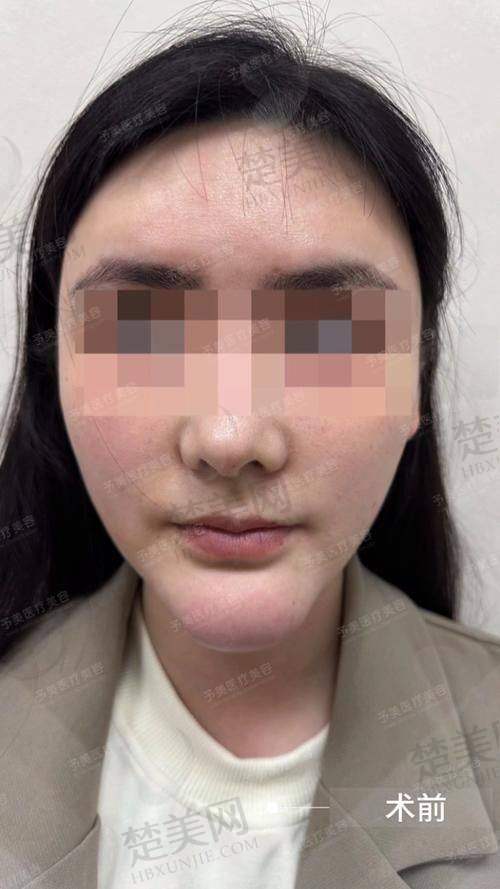 一、Peek材料——整形界的“神秘新秀”
