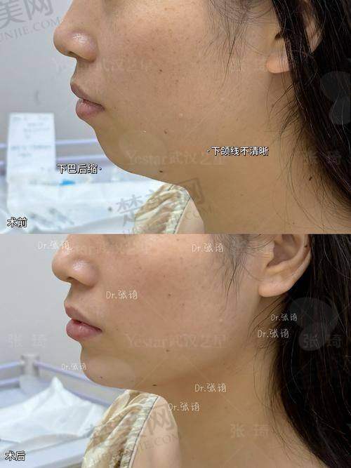 四、真实实例揭秘Peek材质修复下颌骨成效