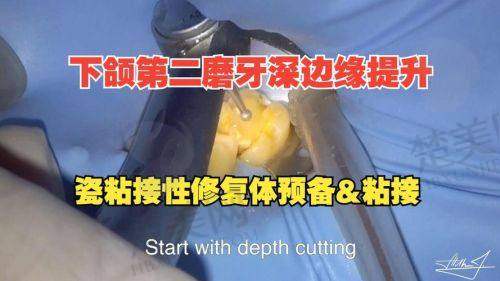 二、Peek材质修复下颌骨的品质优势