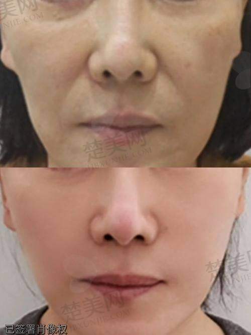 一、苹果肌下垂的困扰