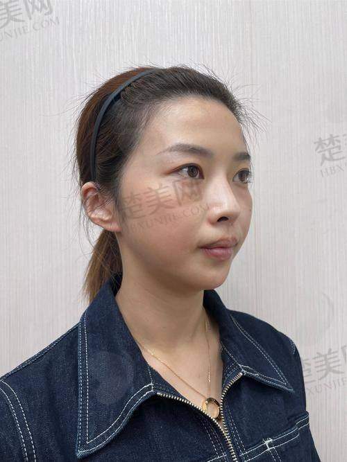 二、常见的苹果肌复位提升方式及费用