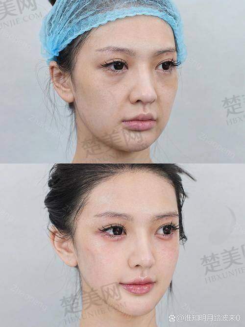 四、如何选择适合自己的苹果肌复位提升术