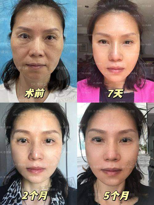 三、影响苹果肌复位提升术费用的其他因素