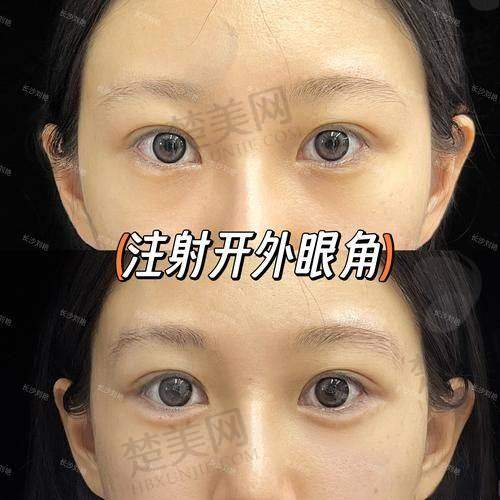 三、眼球脂肪填充的位置
