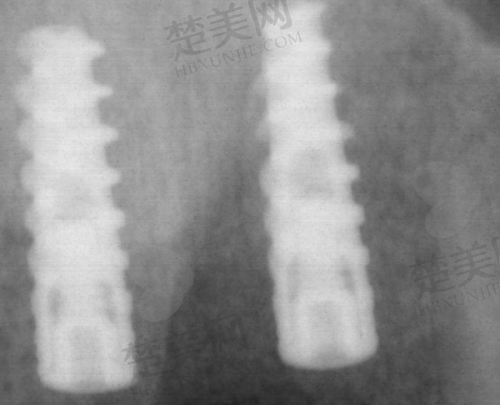 一、西安种植牙公认实力较强的国有医院