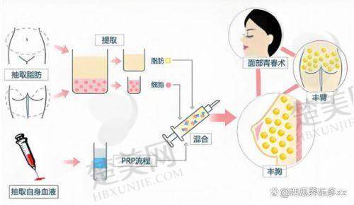 三、郑州做脂肪填充的价格情况