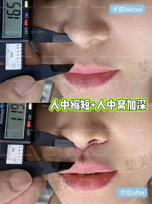 三、人中手术的适应症与成效