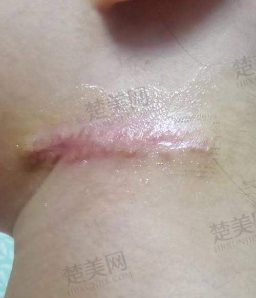三、毛运春医生：微针祛疤轻柔效率高