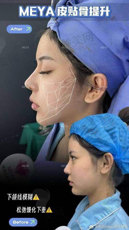 三、面部提升方式怎么选