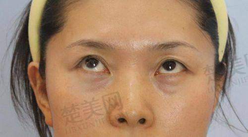 五、不同祛眼袋方法：各有适用人群