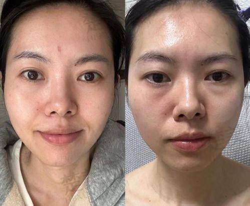 三、内切去眼袋：修复快速成效好