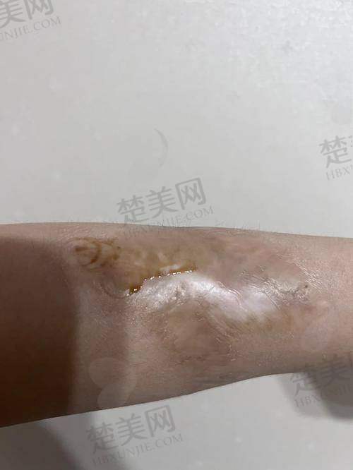 一、昆明祛疤痕好医院排名情况