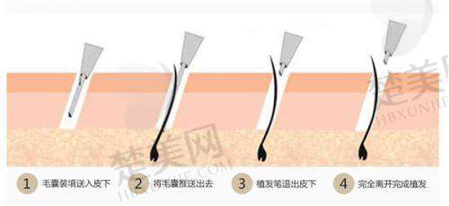 五、临沂卫康医院植发科