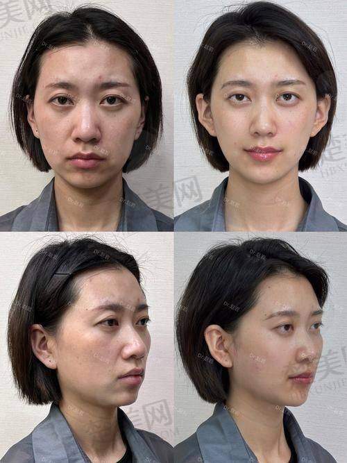 四、韩国ID医院面部轮廓整形项目价格