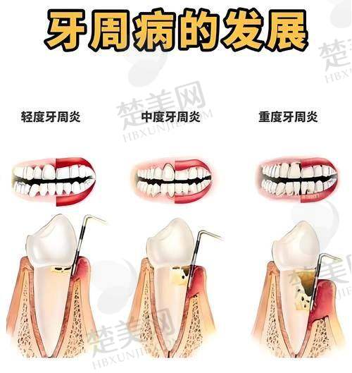 四、重庆牙齿矫正价格影响因素