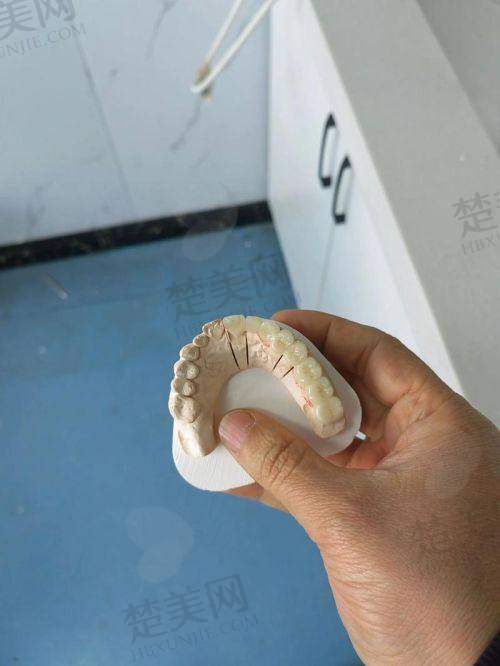 四、影响周口镶牙价格的因素