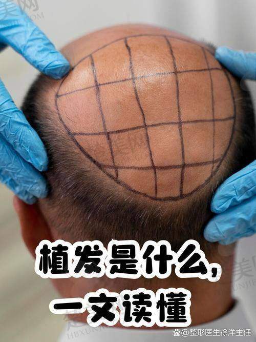 二、厦门碧莲盛植发之医生技术实力