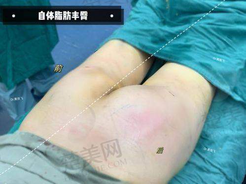 六、选择武汉脂肪丰臀医生的注意事项