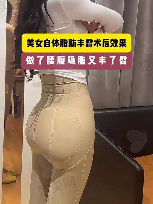 三、武汉脂肪丰臀好的医生是谁啊之付毅医生