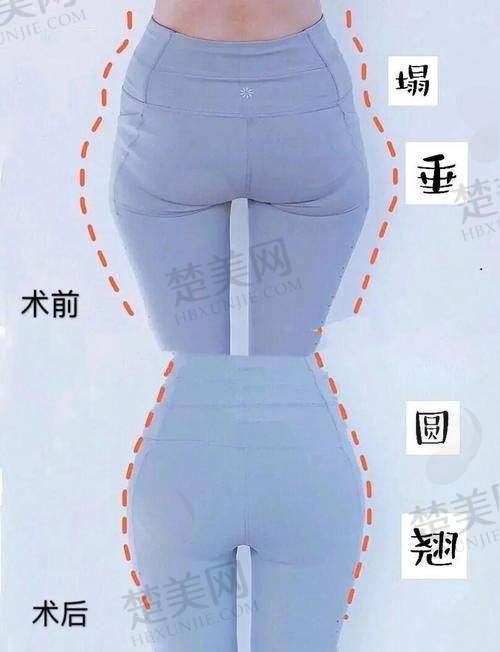 一、武汉脂肪丰臀好的医生是谁啊之姜涛医生