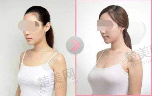五、沈正宇隆胸真实口碑——好评如潮见证实力