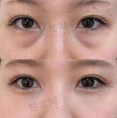 一、广州祛眼袋口碑好的国有医院推荐