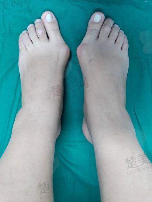 三、北京做大脚骨医生苏敬达之手术适合人群