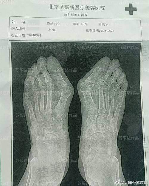 五、北京做大脚骨医生苏敬达与其他医生对比