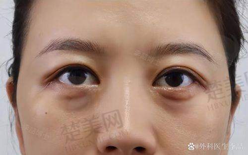 四、深圳贝漾美天曹思佳——术后13天的惊喜