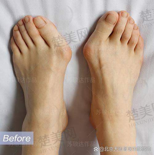 二、苏敬达微孔弧技术：专克失败大脚骨的“修复黑科技”