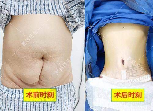 二、重庆腹壁整形价格大揭秘