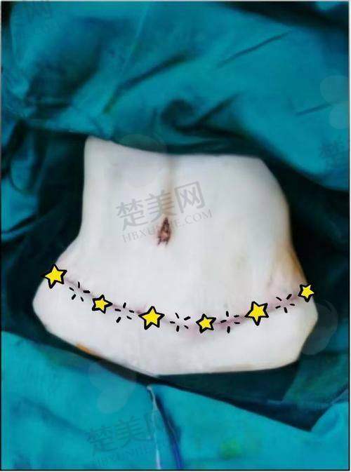 二、李献和医生的技术特色