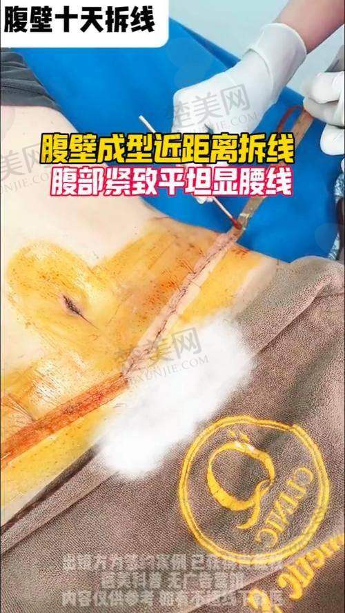 一、成都腹壁成形术排名前十的医生介绍