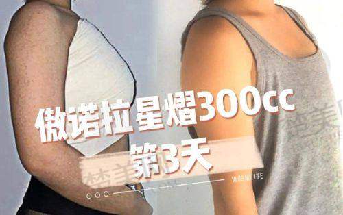 （五）脂肪填充医生