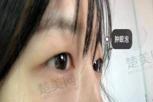 七、潘贰医生 - 广州颜美荟医疗美容医院