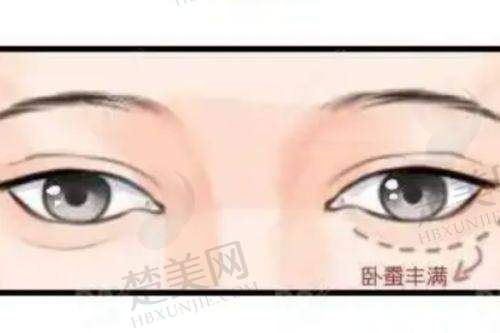 二、薛提朋医生——眼袋去除的高手
