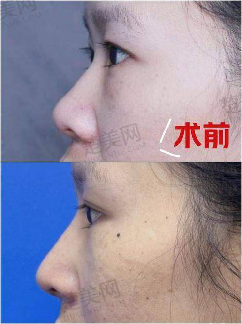 五、重视术后护理：确保手术成效达到至佳