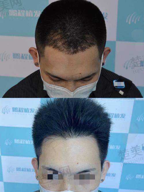 八、福建省厦门医学校附属第二医院皮肤科——注重个性化设计的植发科室