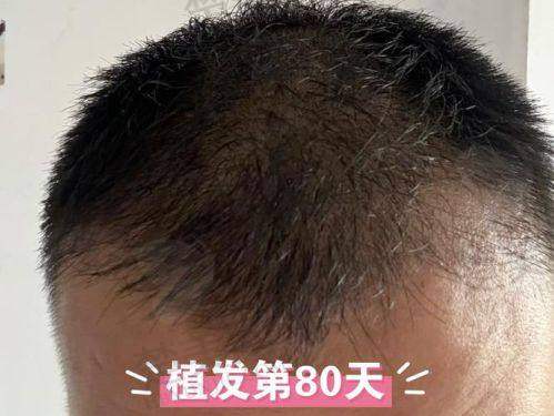 二、厦门碧莲盛植发——植发行业的领军品牌
