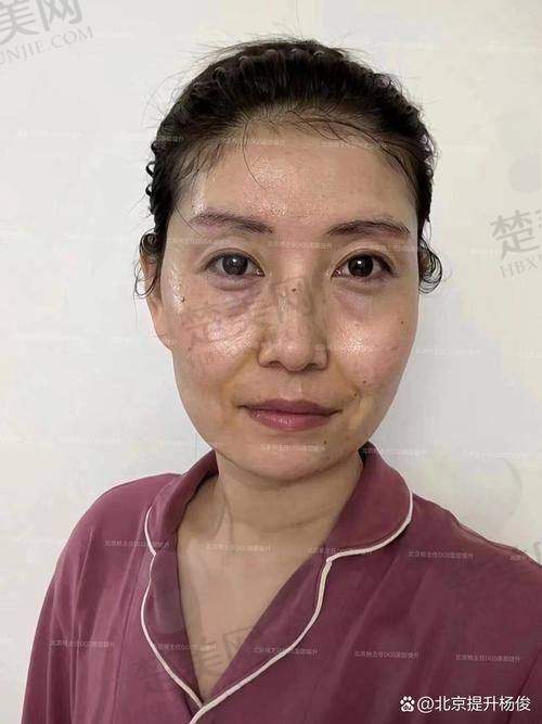 三、袁强博士手术实例分享——56 岁女士跨 700 公里求美