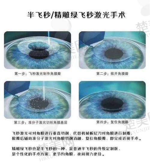 三、成都睛彩眼科的手术体验
