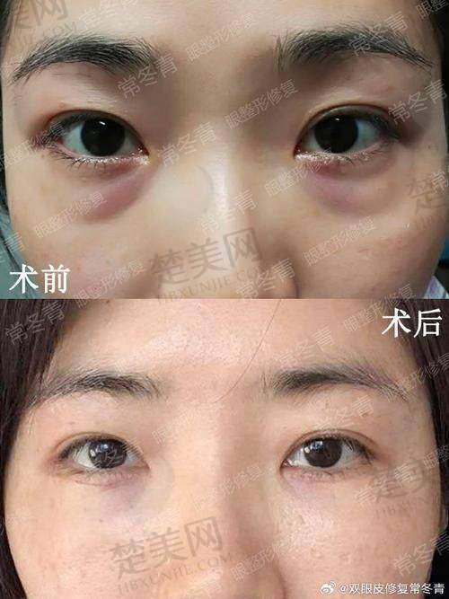 五、深圳朱冠峰医生祛眼袋价格表：费用透明