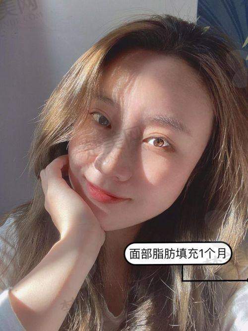 四、影响自体脂肪填充臀费用的其他因素