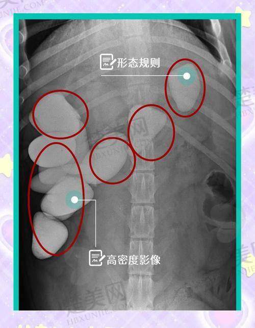 一、医院提醒：术后正常现象导致的肿胀