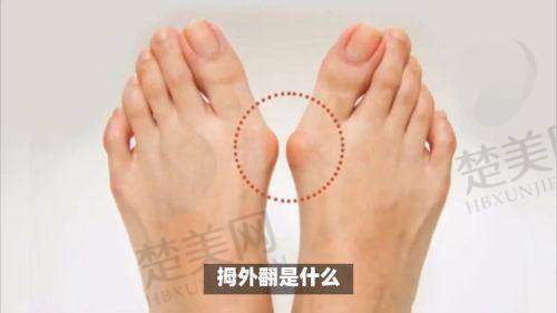 三、温建民医生做拇外翻手术的价格
