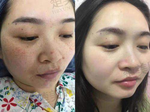 一、南阳华美整形美容医院——祛斑有新招